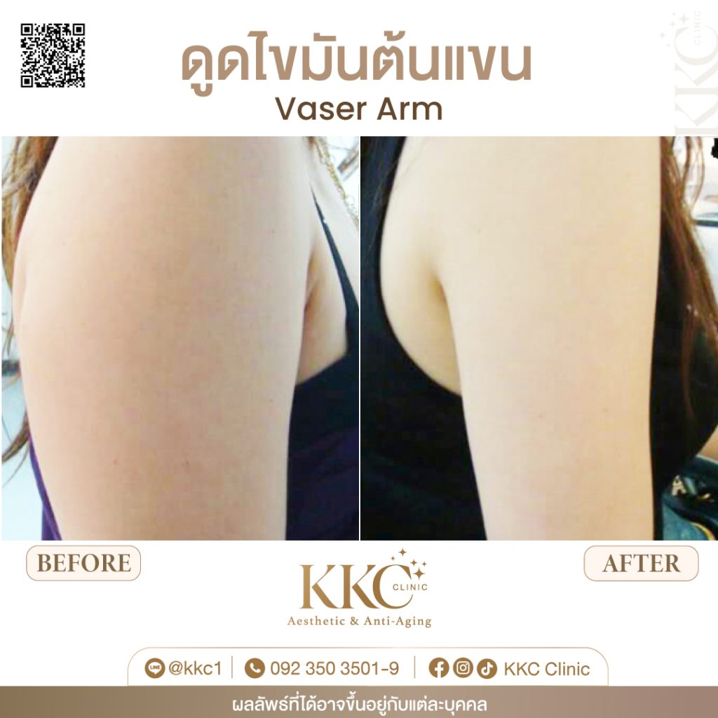 VASER Liposuction in Bangkok at KKC Clinic