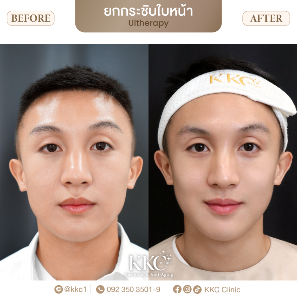 超声刀 (Ultherapy):自然紧致肌肤与胶原蛋白再生技术