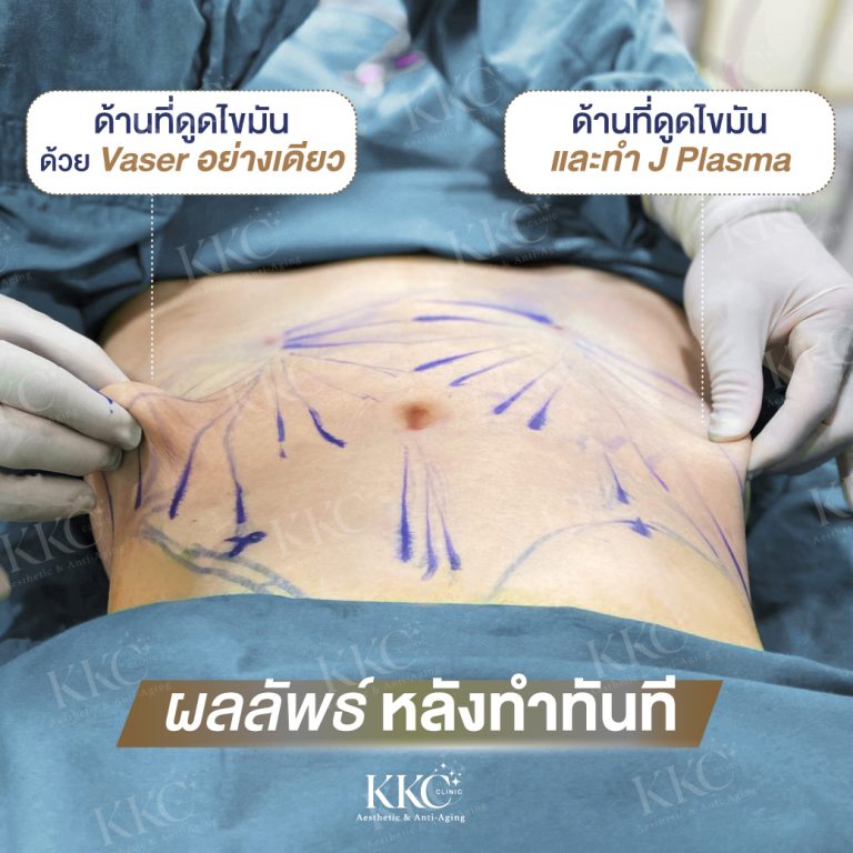 Stomach showing the difference before and after J-Plasma