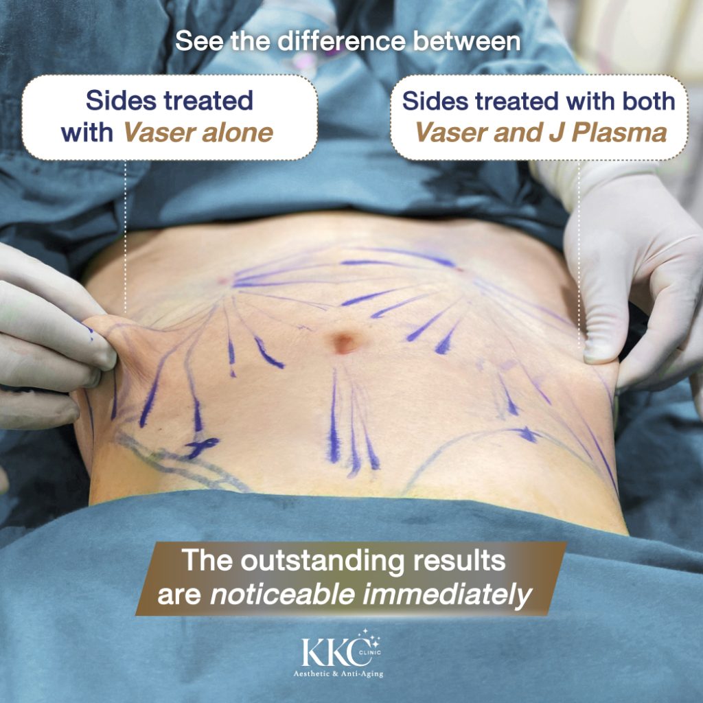 A comparison before and after J-Plasma treatment