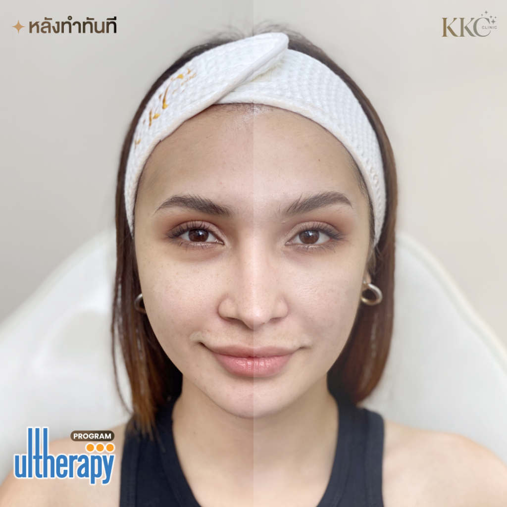 Before and after Ulthera treatment
