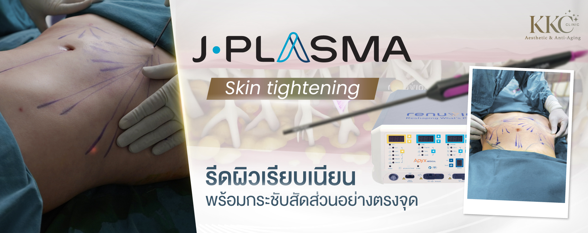 J-Plasma