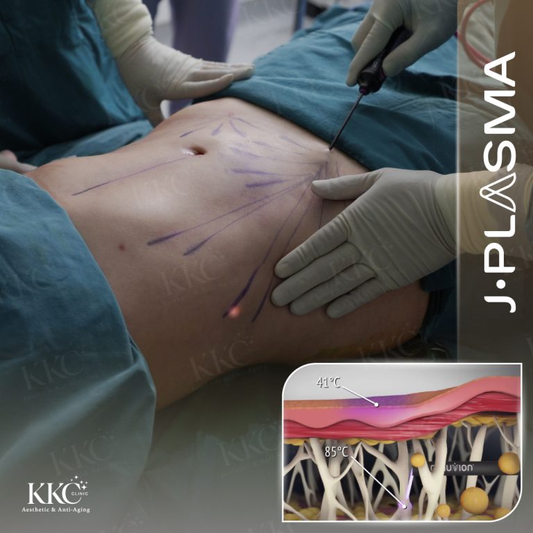 A patient receiving J-Plasma treatment at KKC Clinic