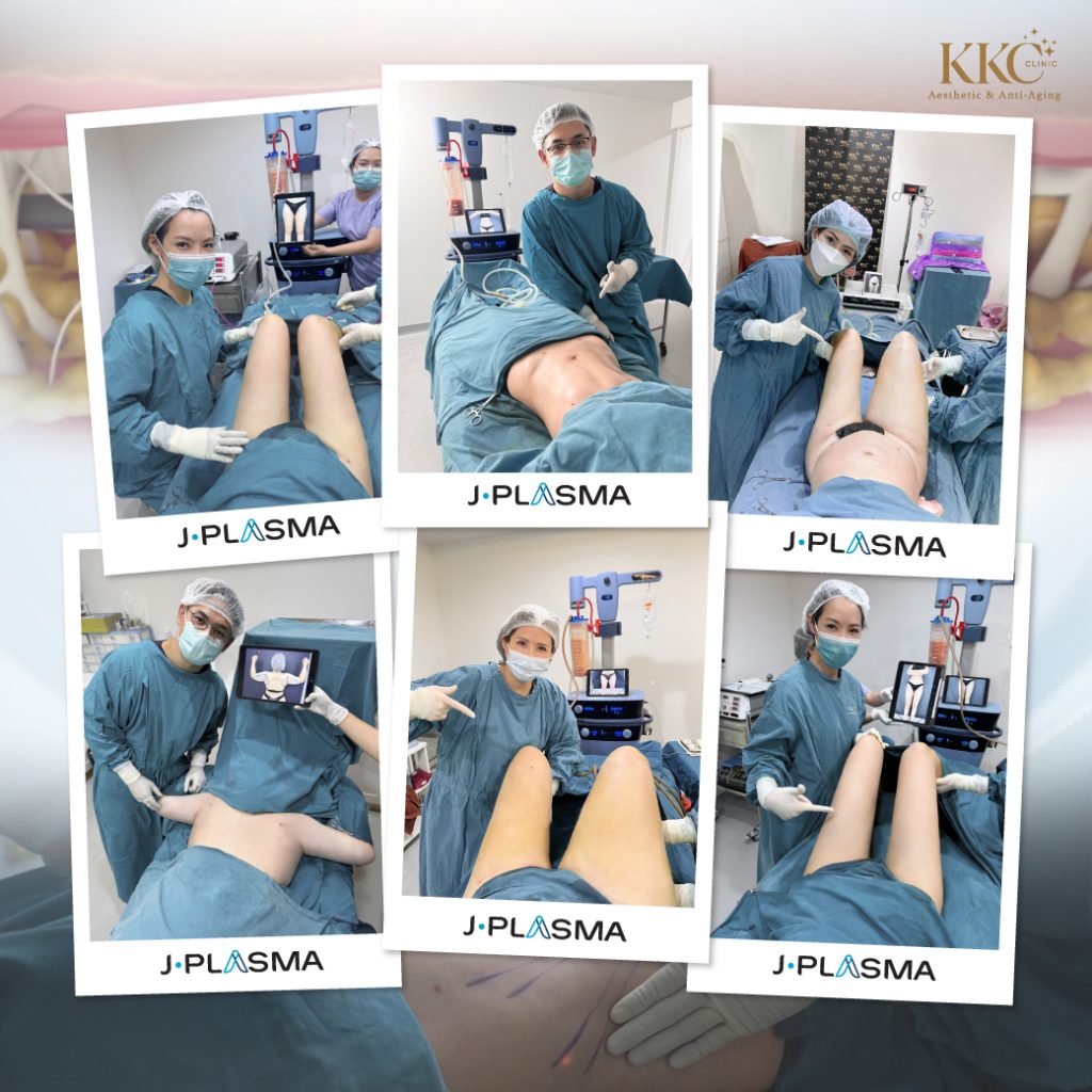 Compilation of images showing clients who have received J-Plasma treatment at KKC Clinic