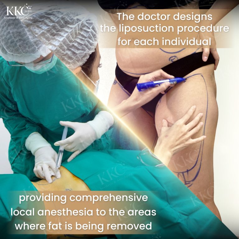 Pre-liposuction procedure