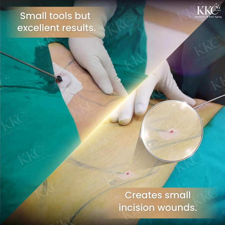 VASER Liposuction incision