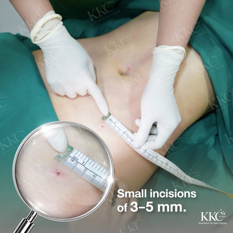 VASER Liposuction incision size
