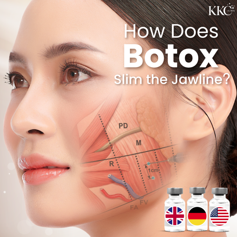 How does Botox slim the jawline