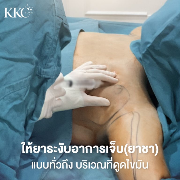 แพทย์กำลังฉีดยาชาเฉพาะที่ให้กับแขนของผู้ป่วยเพื่อเตรียมตัวสำหรับการดูดไขมันที่ KKC Clinic