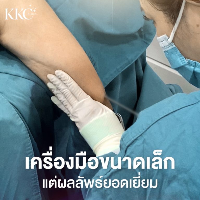 เจ้าหน้าที่ทางการแพทย์ในชุดศัลยกรรมกำลังใช้เครื่องมือขนาดเล็กในการดูดไขมันที่แขนของผู้ป่วย โดยเน้นที่การจัดการอุปกรณ์อย่างแม่นยำและการดูแลผิวหนังของผู้ป่วยอย่างระมัดระวัง