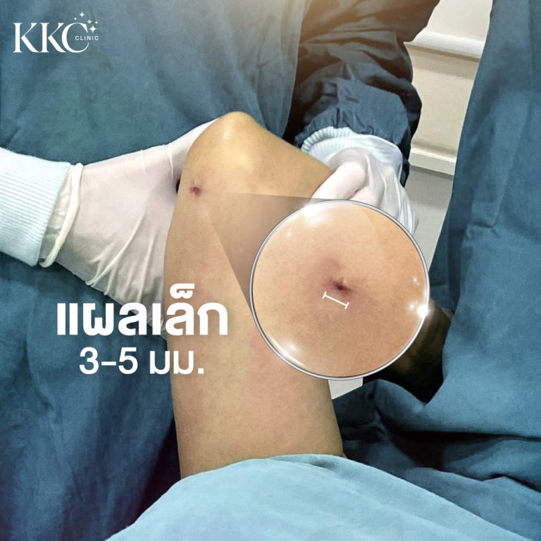 แพทย์ถือแขนของผู้ป่วย แสดงแผลขนาดเล็ก 3-5 มม. หลังการดูดไขมันต้นแขนที่ KKC Clinic