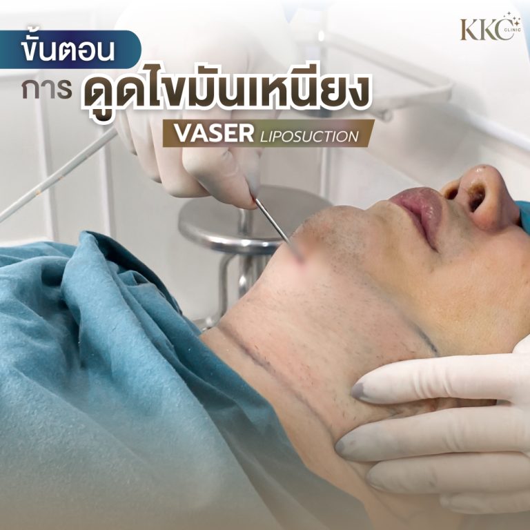 ผู้ป่วยกำลังรับการดูดไขมันเหนียงด้วย VASER ที่ KKC Clinic