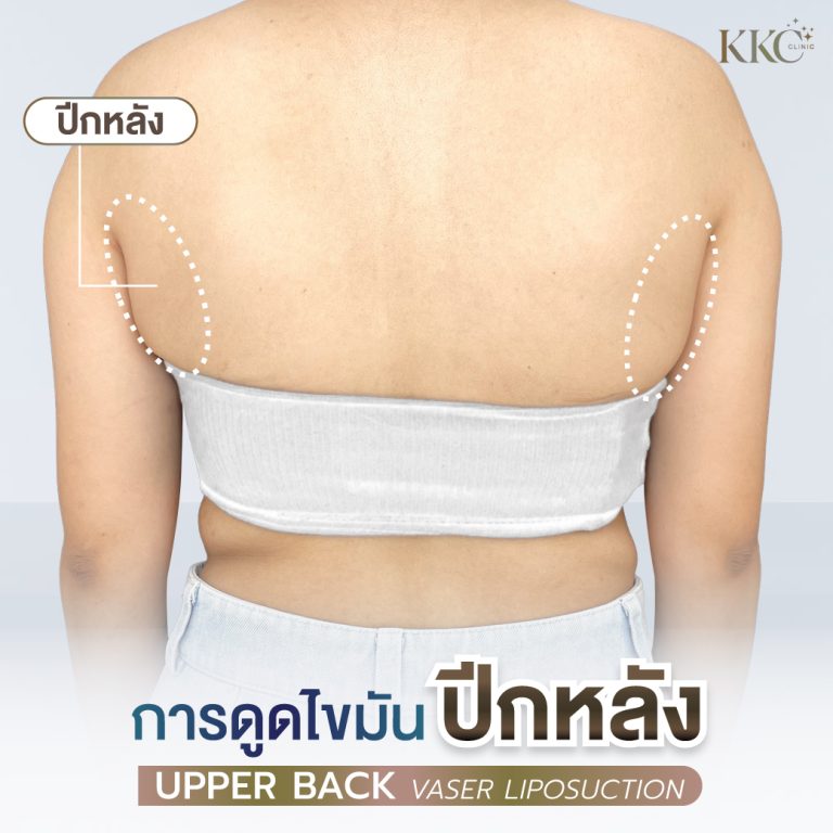 แผ่นหลังของผู้หญิงที่มีเส้นประเน้นบริเวณทั้งสองข้างของปีกหลังที่ทำการดูดไขมัน