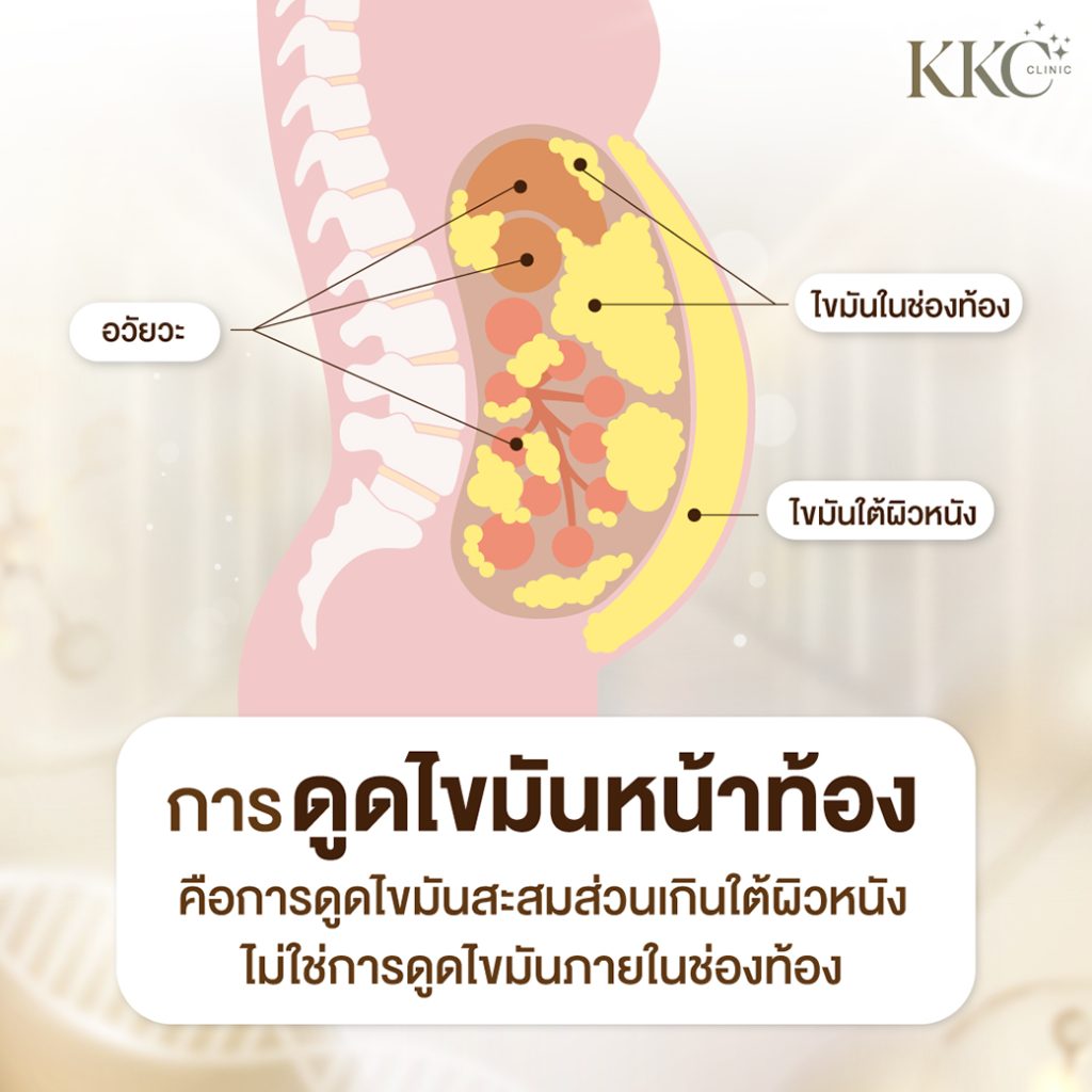 แผนภาพอธิบายการดูดไขมันหน้าท้อง โดยเน้นความแตกต่างระหว่างไขมันใต้ผิวหนังและไขมันในช่องท้อง