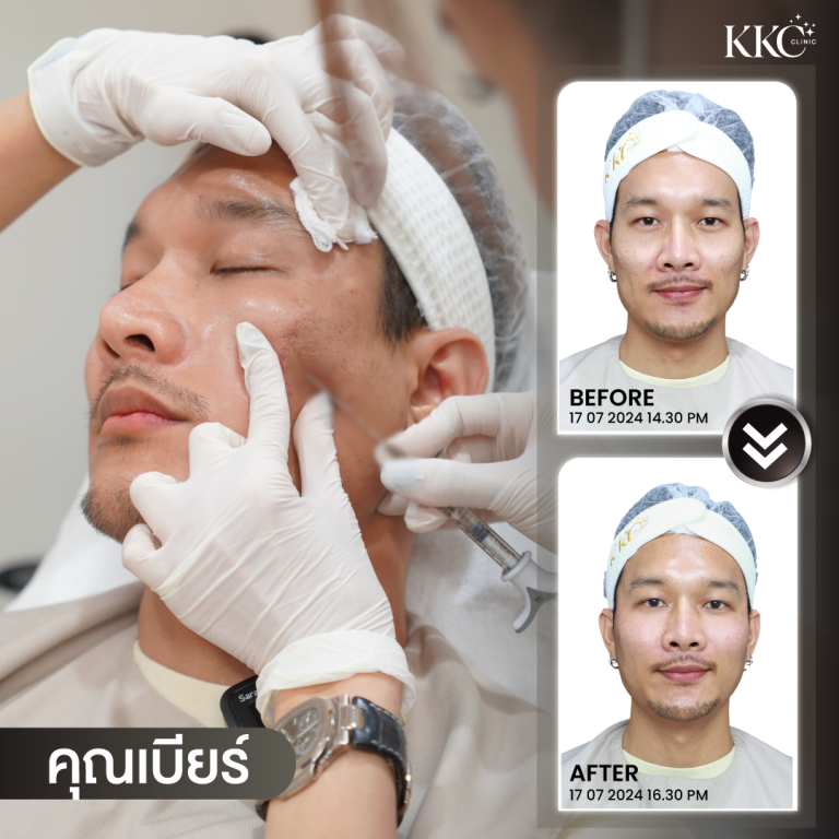 ผู้ชายคนหนึ่งกำลังรับการฉีดยาที่ใบหน้าขณะที่นอนหลับตา