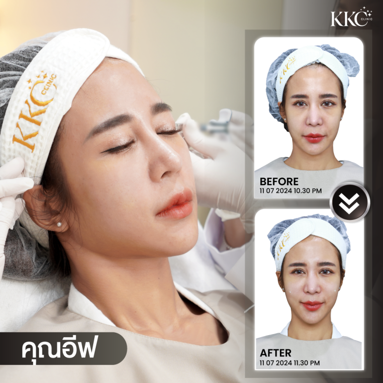 ผู้หญิงคนหนึ่งกำลังรับการฉีดยาที่ใบหน้าขณะที่นอนหลับตา
