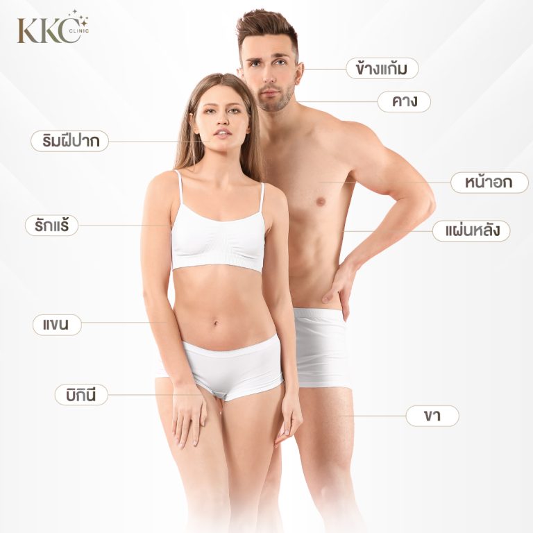 ผู้ชายและผู้หญิงในชุดชั้นในสีขาวแสดงบริเวณต่างๆ สำหรับการกำจัดขนด้วยเลเซอร์ที่ KKC Clinic บริเวณที่มีป้ายชื่อ ได้แก่ ริมฝีปาก รักแร้ แขน บิกินี ข้างแก้ม คาง หน้าอก แผ่นหลัง และขา