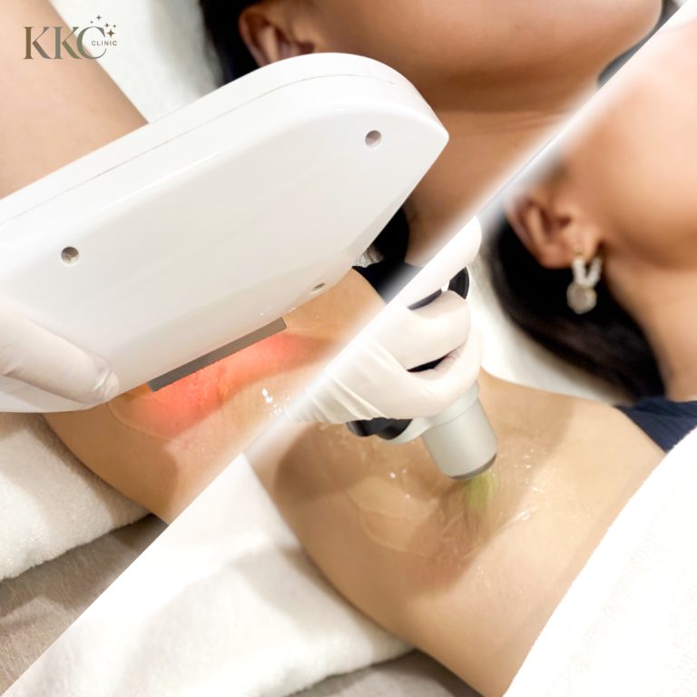 ผู้หญิงกำลังรับการรักษาเลเซอร์กำจัดขนที่ KKC Clinic ภาพประกอบด้วยภาพโคลสอัพสองภาพ: หนึ่งภาพแสดงอุปกรณ์เลเซอร์ปล่อยแสงสีแดงที่รักแร้ของเธอ และอีกภาพแสดงอุปกรณ์ที่ใช้ในบริเวณเดียวกัน