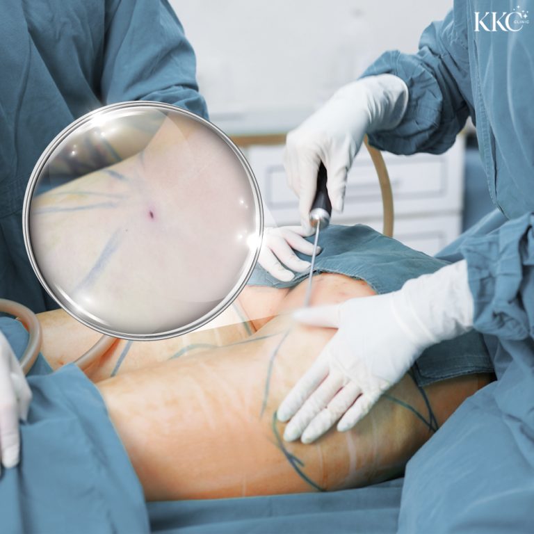 A patient undergoing VASER liposuction on the thigh.