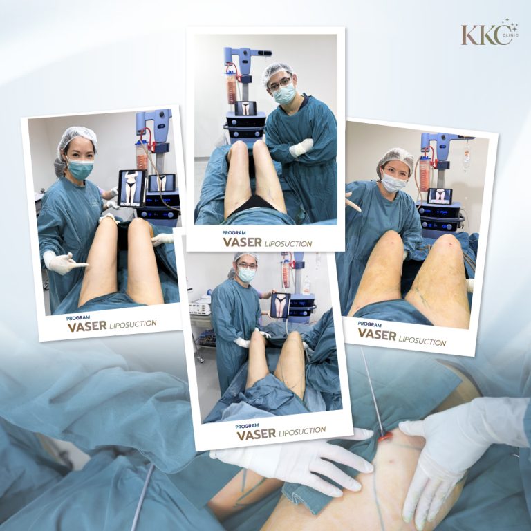 A collage of images showcasing the VASER liposuction procedure on a patient's thighs.