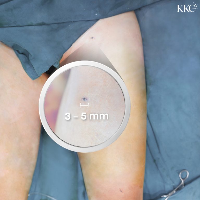 Close-up view of a small incision on a patient's thigh with a magnified section highlighting the incision size, which is approximately 3–5 mm.
