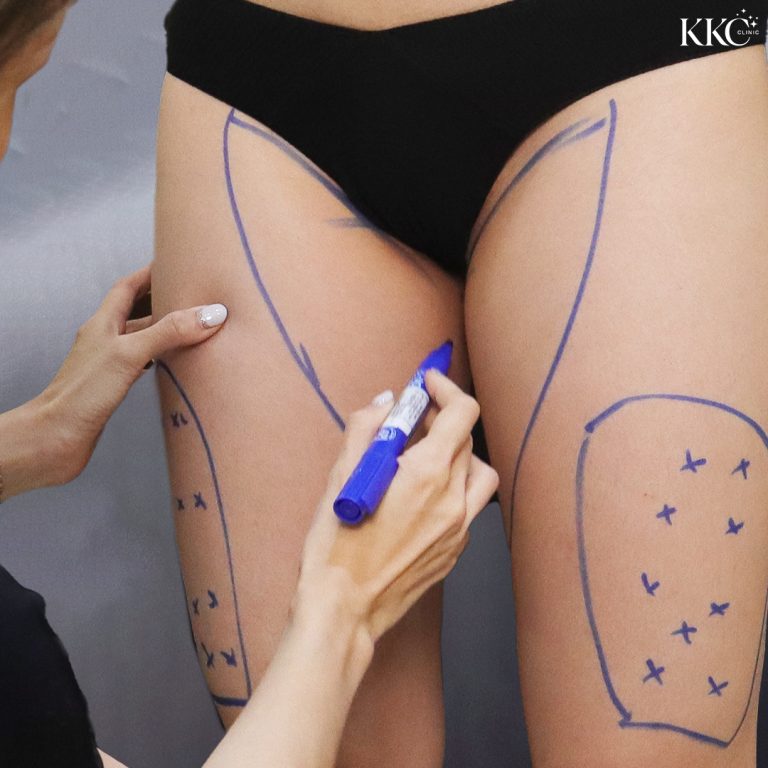 A close-up view of a patient's thighs with pre-operative markings made by a doctor, outlining the areas for VASER liposuction.