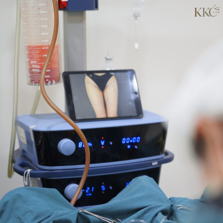 A close-up view of a VASER liposuction machine during a procedure.