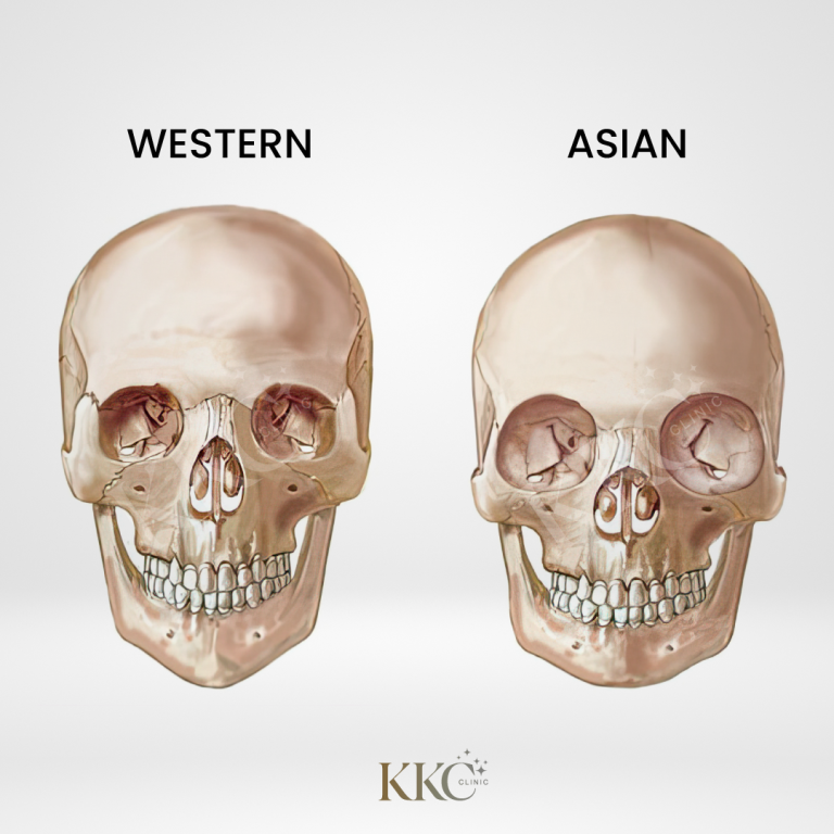 การเปรียบเทียบโครงกระดูกศีรษะระหว่างสองแบบที่วางคู่กัน โดยมีป้ายกำกับว่า "Western" ทางด้านซ้าย และ "Asian" ทางด้านขวา แสดงให้เห็นถึงความแตกต่างของโครงสร้างกระดูกใบหน้าระหว่างประชากรชาวตะวันตกและชาวเอเชีย