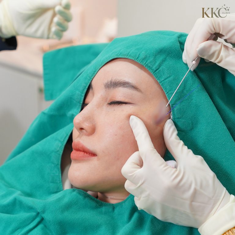 ผู้หญิงกำลังรับการรักษาร้อยไหมบนใบหน้าที่ KKC Clinic โดยมีบุคลากรทางการแพทย์สอดไหมใต้ผิวหนัง ขณะที่เธอสวมผ้าคลุมสีเขียว