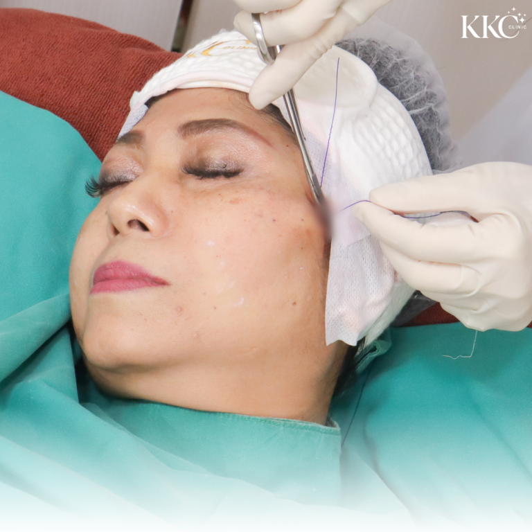 ผู้หญิงกำลังรับการทำหัตถการร้อยไหมเพื่อปรับรูปหน้าที่ KKC Clinic