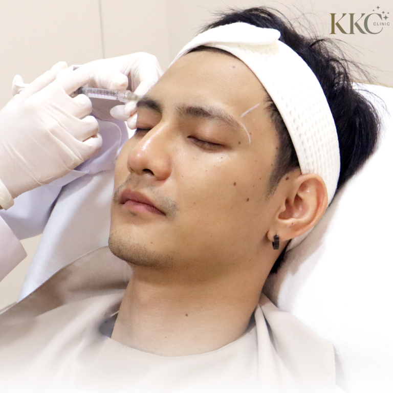 ผู้ป่วยชายกำลังรับการฉีดฟิลเลอร์ที่ KKC Clinic โดยแพทย์กำลังฉีดบริเวณขมับเพื่อปรับรูปหน้า