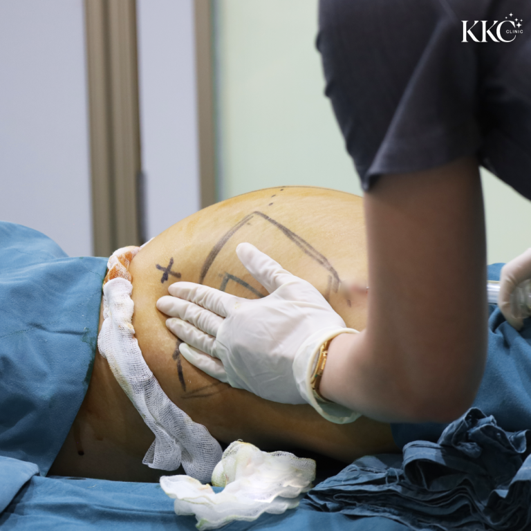 แพทย์ที่ KKC Clinic กำลังนวดบริเวณสะโพกของผู้ป่วยหลังจากฉีดฟิลเลอร์แล้ว มีเส้นเครื่องหมายก่อนการรักษาปรากฏบนผิวหนังของผู้ป่วย และผู้ป่วยนอนคว่ำ