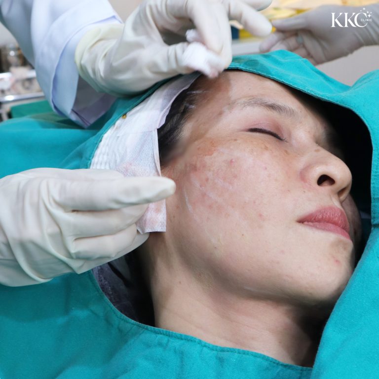 ผู้ป่วยกำลังเข้ารับการรักษาร้อยไหมที่ KKC Clinic โดยมีแพทย์สวมถุงมือกำลังดำเนินการรักษาอย่างระมัดระวังบริเวณด้านข้างของใบหน้าผู้ป่วย