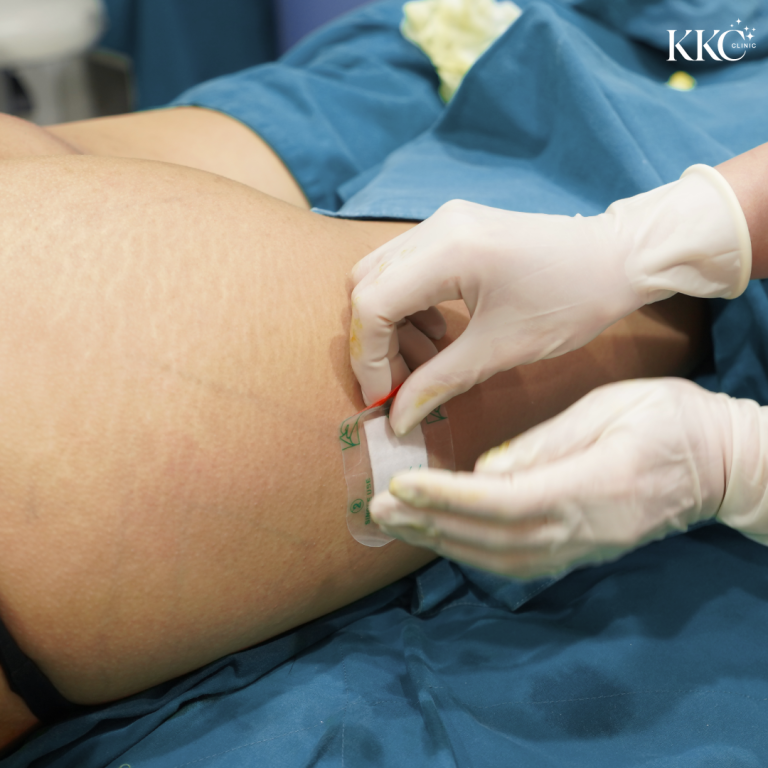 มุมมองระยะใกล้ของแพทย์ที่ KKC Clinic กำลังติดพลาสเตอร์ปิดแผลบริเวณสะโพกของผู้ป่วยหลังจากเสร็จสิ้นการฉีดฟิลเลอร์ ผู้ป่วยนอนคว่ำและคลุมด้วยผ้าปลอดเชื้อ