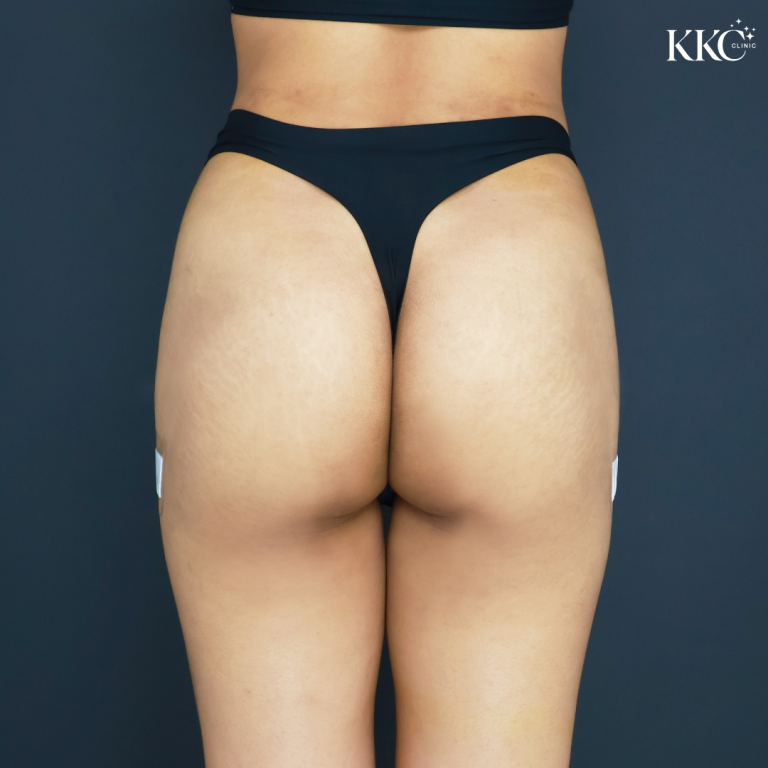 ภาพด้านหลังของสะโพกผู้ป่วยหลังจากได้รับการฉีดฟิลเลอร์สะโพกที่ KKC Clinic ผู้ป่วยสวมกางเกงชั้นในสีดำและมีพลาสเตอร์ปิดแผลเล็ก ๆ ที่สะโพกทั้งสองข้าง