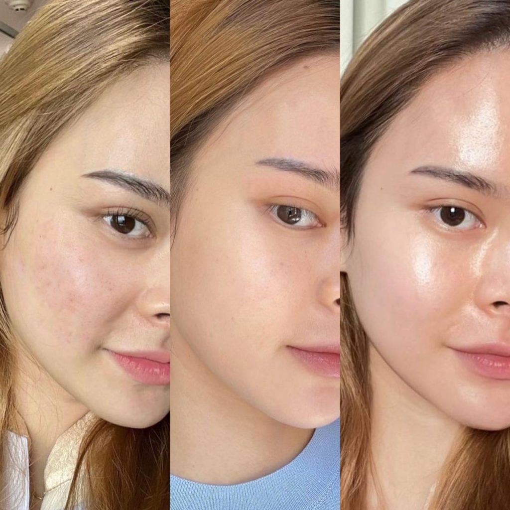ภาพเปรียบเทียบผิวของผู้หญิงก่อนและหลังการรับการรักษา Skinvive โดยแสดงความเปลี่ยนแปลงจากผิวที่มีสิวและหมองคล้ำไปเป็นผิวที่เรียบเนียนและกระจ่างใสขึ้น