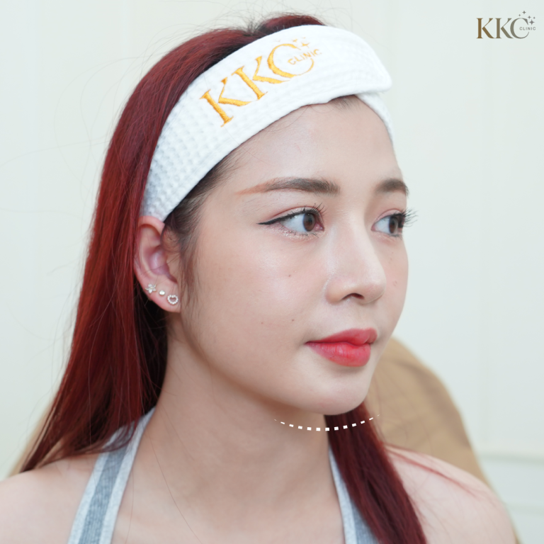 ผู้หญิงผมสีแดงสวมผ้าคาดผม KKC Clinic แสดงให้เห็นรูปคางที่ได้รับการปรับปรุงหลังจากการฉีดฟิลเลอร์คาง