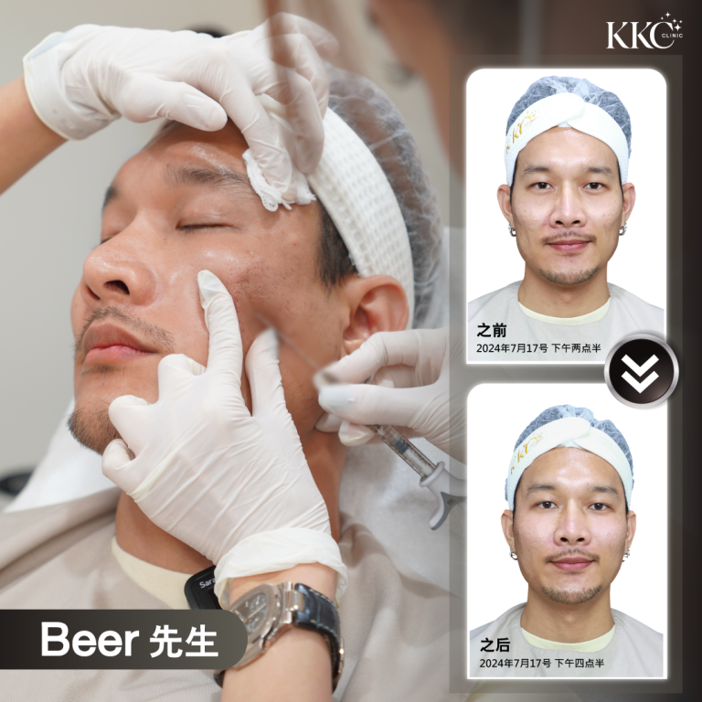 一位名叫 Beer 的男子正在接受面部填充注射，左侧是注射过程的特写。