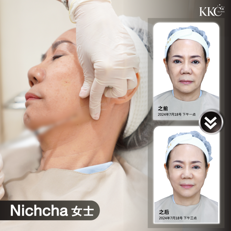 一位名叫 Nichcha 的女士正在接受面部填充注射，左侧为注射过程的特写。