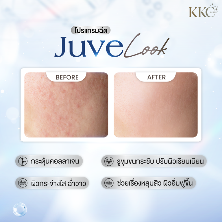 ภาพเปรียบเทียบก่อนและหลังการฉีด JuveLook ที่ KKC Clinic ภาพ "ก่อน" แสดงผิวที่มีรูขุมขนกว้างและพื้นผิวหยาบ ส่วนภาพ "หลัง" แสดงผิวที่เรียบเนียนและกระจ่างใส ข้อความด้านล่างเน้นประโยชน์เช่น กระตุ้นคอลลาเจน ผิวกระจ่างใส รูขุมขนกระชับ และช่วยเรื่องหลุมสิว
