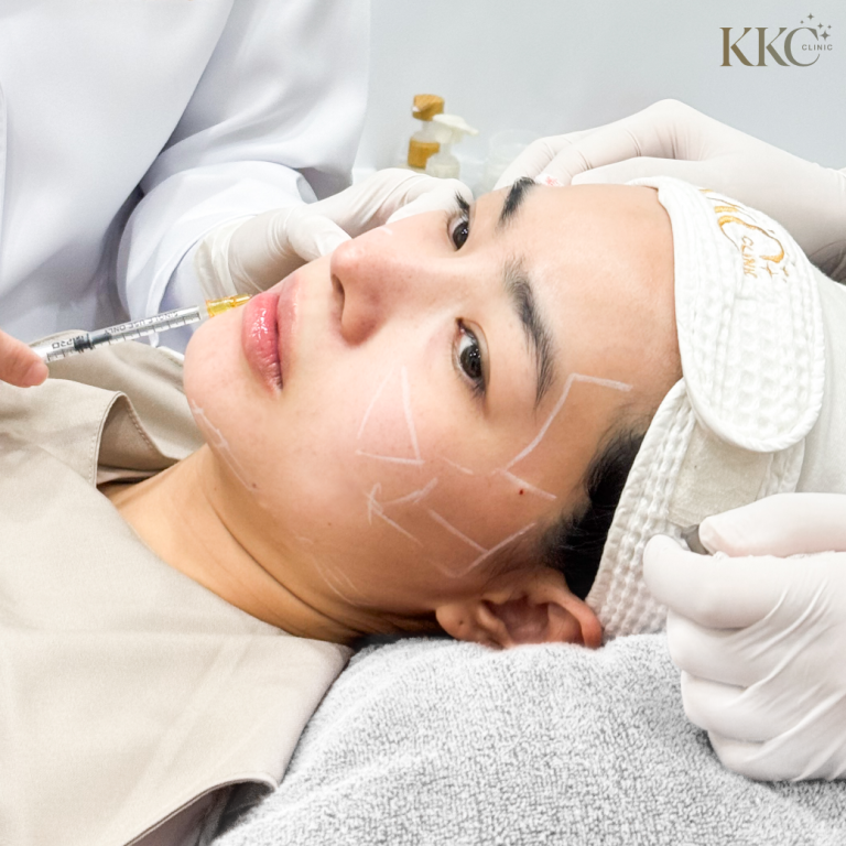 ผู้ป่วยกำลังรับการฉีด JuveLook ที่ KKC Clinic ขณะนอนราบ มีการมาร์กจุดบนใบหน้า และผู้เชี่ยวชาญทางการแพทย์กำลังฉีดบริเวณคาง