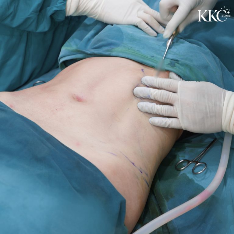 แพทย์กำลังทำการดูดไขมันด้วย VASER บนหน้าท้องของผู้ป่วยที่ KKC Clinic ผู้ป่วยนอนราบพร้อมเครื่องมือผ่าตัดและท่อข้างกาย แพทย์ใช้เครื่องมือคานูล่าเพื่อกำจัดไขมันส่วนเกิน