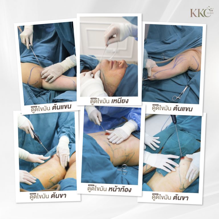 ภาพคอลลาจ 5 ภาพแสดงส่วนต่าง ๆ ของร่างกายที่กำลังทำการดูดไขมันด้วย VASER รวมถึงต้นแขน ต้นขา ใบหน้า และหน้าท้อง แพทย์ใช้เครื่องมือทางการแพทย์ทำการดูดไขมัน และร่างกายของผู้ป่วยมีการมาร์กเพื่อเตรียมการดูดไขมันที่ KKC Clinic