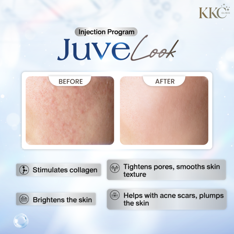 JuveLook injection program before-and-after comparison showing skin improvement. The "before" image depicts uneven texture with visible pores, while the "after" image shows smoother, brighter skin. Benefits listed include collagen stimulation, skin brightening, pore tightening, smoother texture, help with acne scars, and skin plumping.