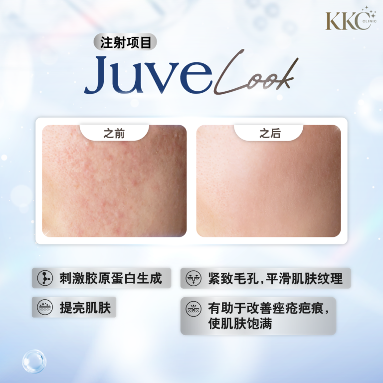 JuveLook注射项目的前后对比，展示皮肤改善效果。前图显示皮肤质地不均，毛孔明显，后图显示皮肤更光滑亮泽。列出的益处包括刺激胶原蛋白、提亮肤色、收紧毛孔、平滑肤质、帮助修复痘疤和丰盈肌肤。