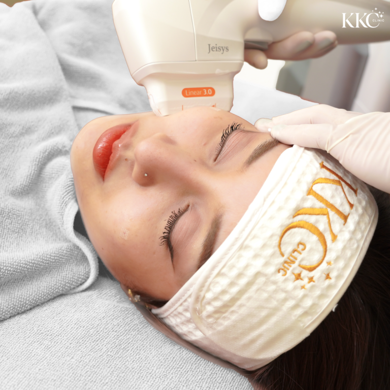 ผู้หญิงกำลังรับการทำ HIFU บริเวณใบหน้า ด้วยเครื่อง Jeisys Linear 3.0 ที่ KKC Clinic