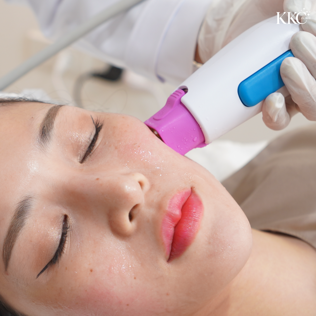 ภาพระยะใกล้ของใบหน้าคนไข้ขณะทำทรีตเมนต์ Thermage โดยมีหัวทรีตเมนต์สัมผัสแก้มอย่างอ่อนโยน