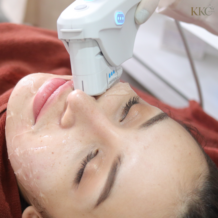 ภาพใกล้ของหญิงสาวที่กำลังรับการทำ Ultherapy ที่ KKC Clinic โดยมีอุปกรณ์มือถือสัมผัสที่แก้มเพื่อยกกระชับผิว