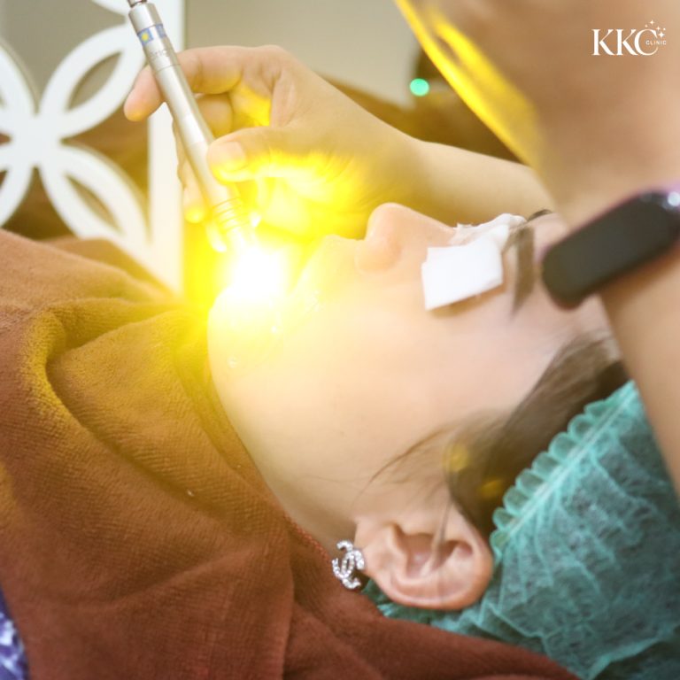 ผู้เข้ารับการรักษาด้วย Dual Yellow Laser บริเวณส่วนล่างของใบหน้า โดยมีแสงเลเซอร์สีเหลืองส่องเน้นที่คาง และมีผ้าปิดตาป้องกัน