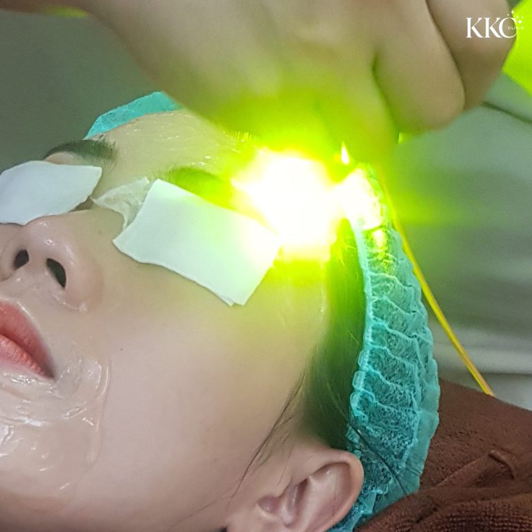 ภาพระยะใกล้ของผู้เข้ารับการรักษาด้วย Dual Yellow Laser พร้อมแสงเลเซอร์สีเหลือง-เขียวส่องเน้นที่หน้าผาก และมีผ้าปิดตาป้องกัน